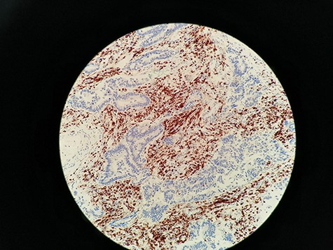 Immunohistochemistry staining for CD3+ TILs in 60_CD3_CT image. CD3 lymphocytes in CT are highlighted.