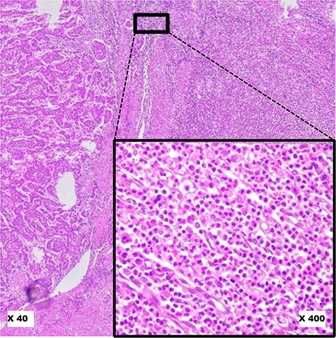 Pitfalls to avoid in selecting ‘Hot Spot’ areas on HE slides. This image shows a robust inflammatory response in the tumour microenvironment at low magnification (×40). At higher magnification (×400), it reveals a polymorphic inflammatory infiltrate particularly rich in neutrophilic granulocytes, which should not be considered.