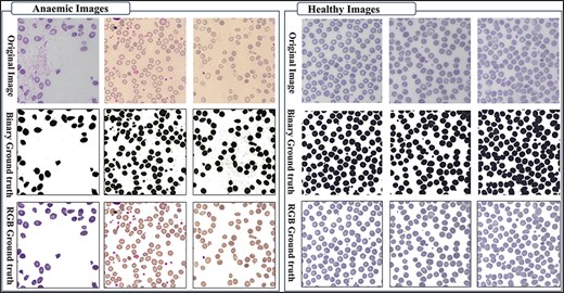 Original images along with segmented binary, and RGB ground truth of healthy and anemic samples.