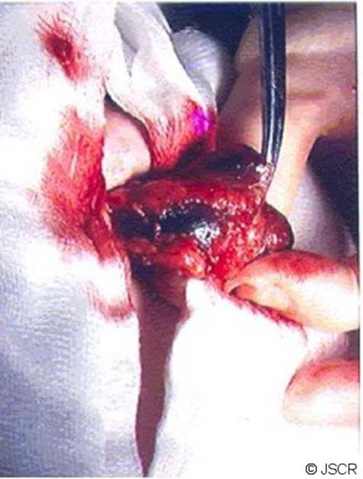 Contents of hernia sac