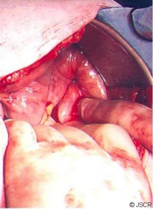 Peritoneal defect at origin of femoral canal.