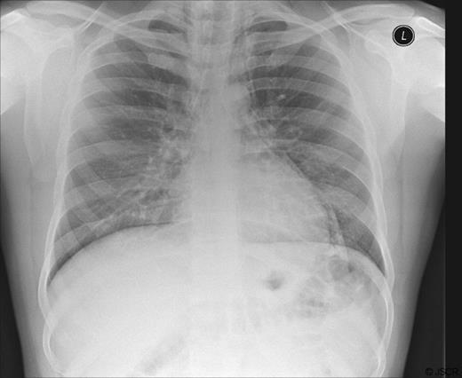 Chest radiograph demonstrating pneumomediastinum.