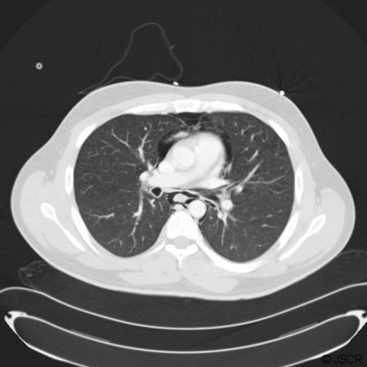 CT scan demonstrating pneumomediastinum.