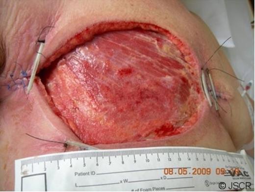 Debrided wound illustrating triangulation.