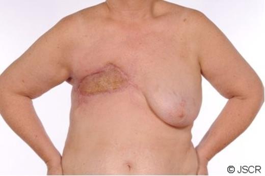 Eventual appearance of the wound following skin graft.