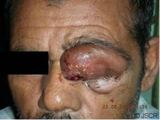 left upper eyelid swelling with an ulcerated wound on its nasal aspect.