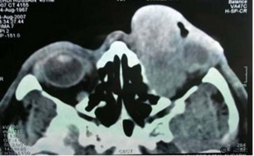 An axial CT showing tumor mass extending deep into the orbit.