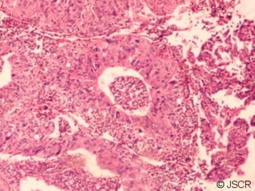 Photomicrograph showing (a) Tumor cells arranged in irregular, lobular formation with central necrosis ( H & E, 125x ) (b)Polyhedral tumor cells with central atypical nuclei, vacuolated eosinophilic cytoplasm and abnormal mitosis ( H & E, 250x ).