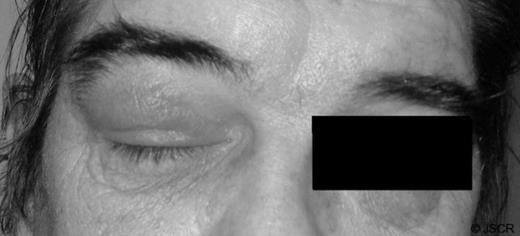 Right ptosis due to enormously swollen upper lid
