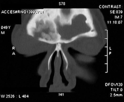 CT scan showing defect in the right superior orbital rim and periorbital soft tissue swelling. Also seen are the inflamed sinus cavities.