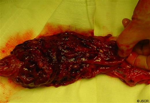 Red Carpet of the rectum