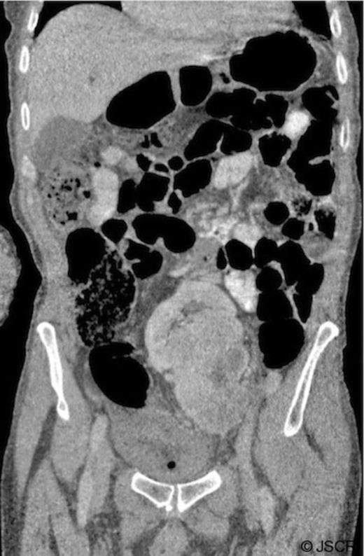 CT of the abdomen and pelvis with oral and intravenous contrast. Coronal image showing a reniform mass in the central pelvis: a presumed left pelvic kidney with a complex heterogenous mass arising and extending inferiorly.