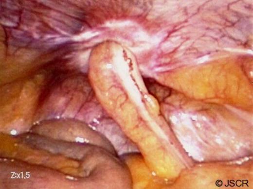 Incarcerated appendix