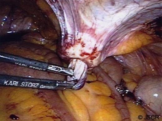 Reduction of the hernia sac