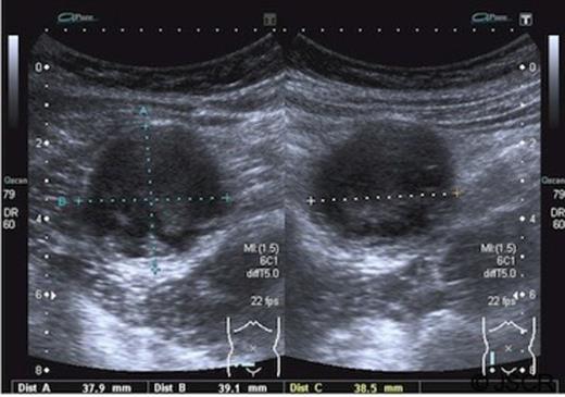 Ultrasound images showing a spherical cystic lesion with layering within