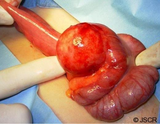 Intraoperative picture showing a spherical lesion at the ileocaecal junction