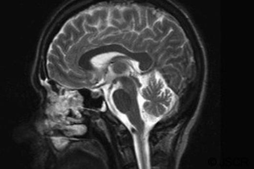 MRI Brain