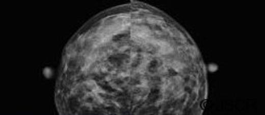 Breast mammogram