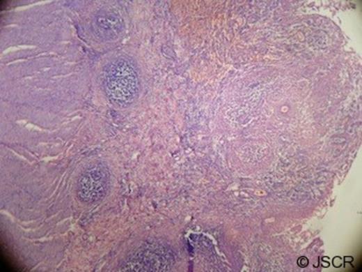 Low power photomicrograph showing mucosal ulceration of intestinal wall with hemorrhage and collection of lymphocytes (× 100)