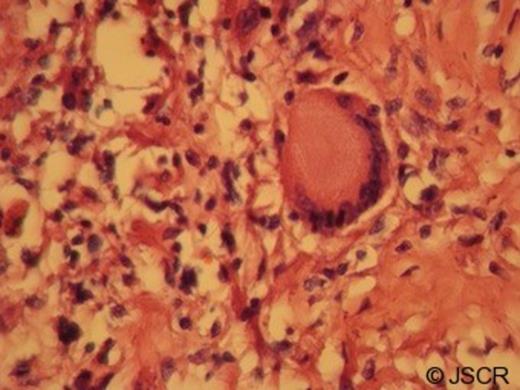 Photomicrograph showing Langhans giant cell (×400)