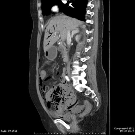 CT scan showing portal venous gas and pneumatosis intestinalis in a large intraabdominal cystic mass (Gangrenous Meckel’s Diverticulum)