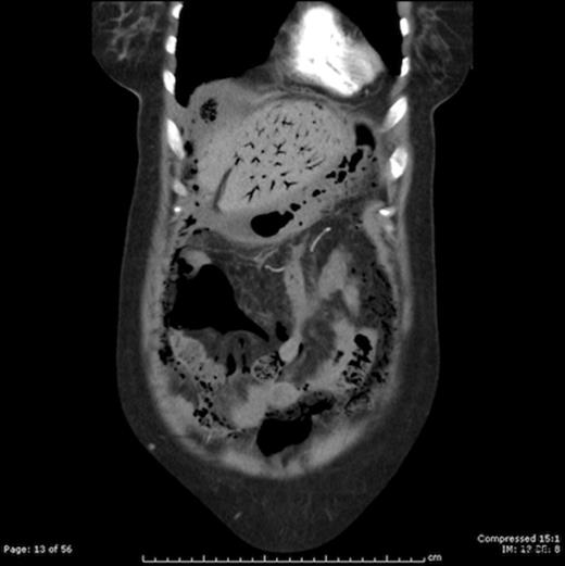 CT scan showing extensive portal venous gas