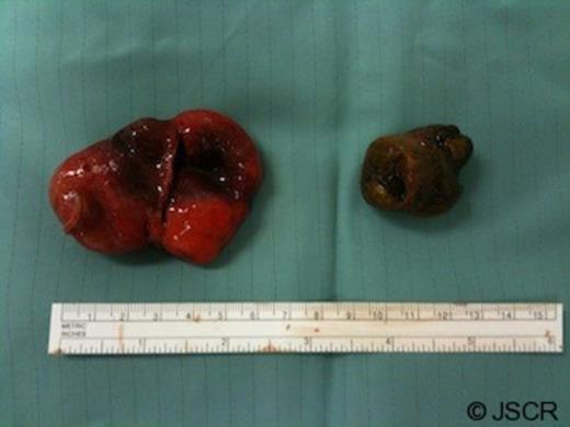 Resected Meckel’s diverticulum and the giant faecalith it contained