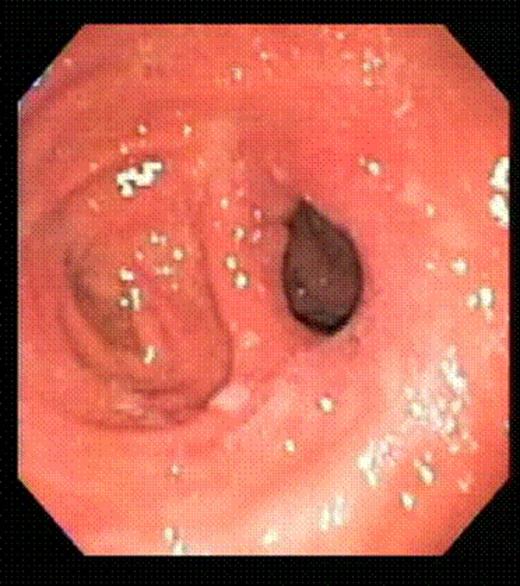 Gastrojejunal stoma before endoluminal gastric pouch plication
