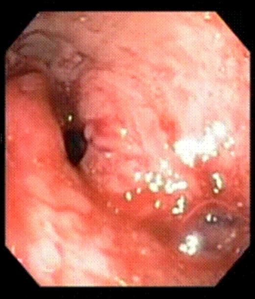 Gastrojejunal stoma immediately after endoluminal gastric pouch plication