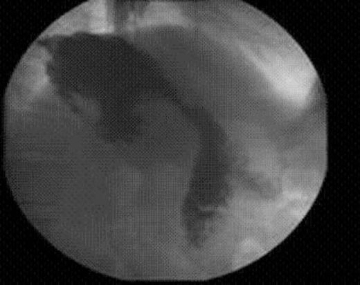 Upper GI Series before endoluminal gastric pouch plication