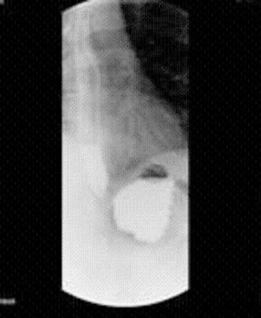 Upper GI Series 2 months after endoluminal gastric pouch plication