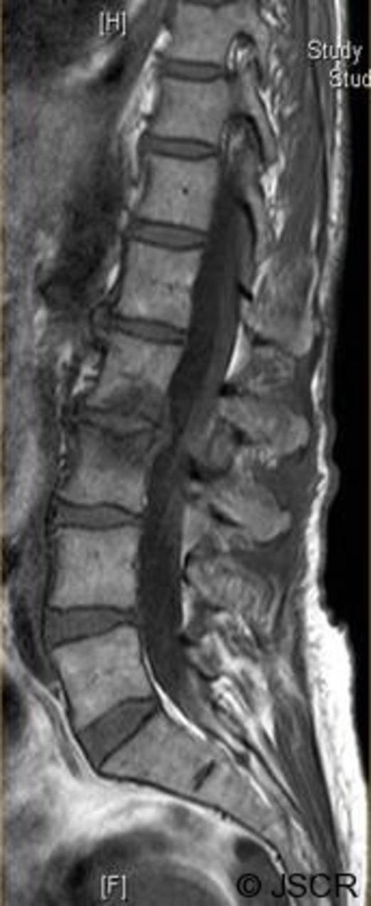 Preoperative sagittal T1 weighted image showing disc bulge at L2/3