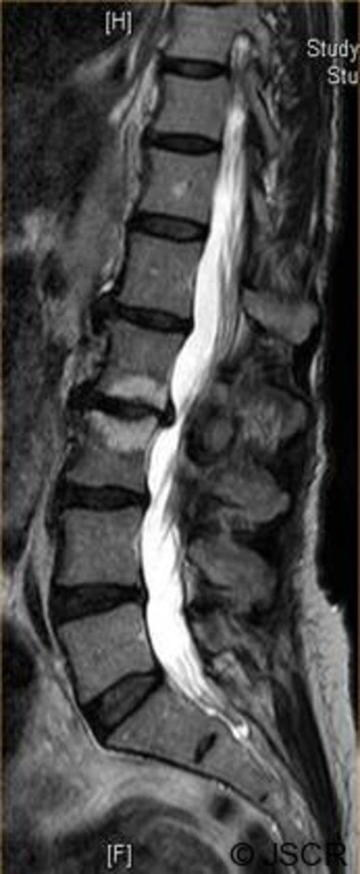 Preoperative sagittal T2 weighted image showing disc bulge at L2/3