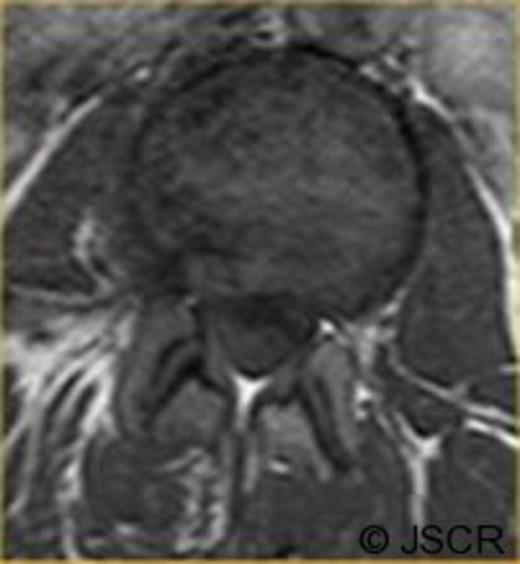 Preoperative axial T1 weighted image showing disc bulge at L2/3 to the right.