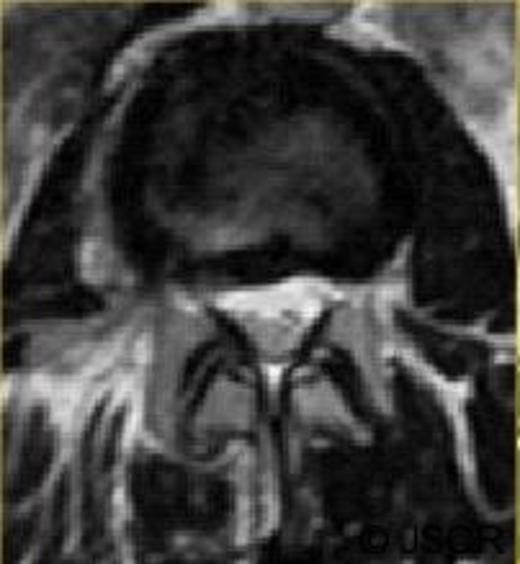 Preoperative axial T2 weighted image showing disc bulge at L2/3 to the right.