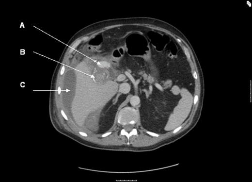 CT angiogram (A = cystic artery pseudoaneurysm; B = calcified gallstone; C = perihepatic fluid)