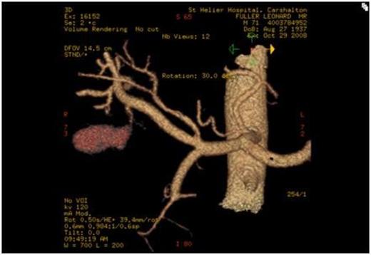 3d reconstruction of CT angiogram