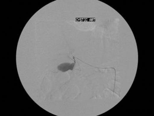 Transfemoral microcoil embolisation of the cystic artery.