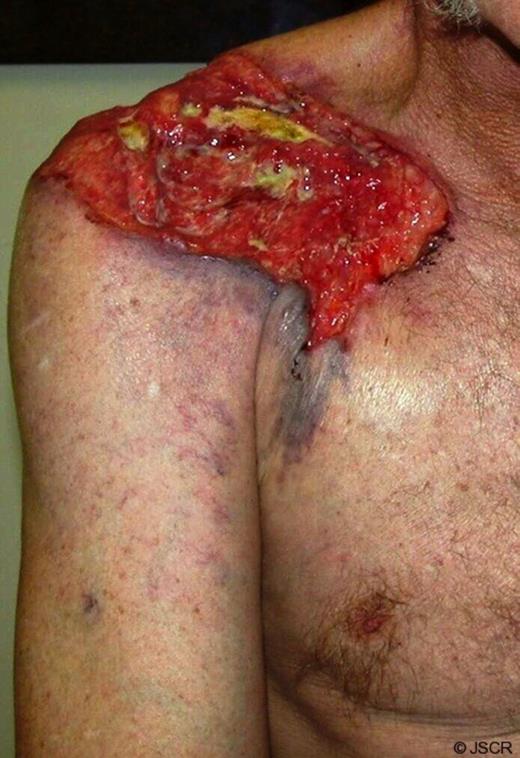 Anterior view of presenting lesion on right shoulder.