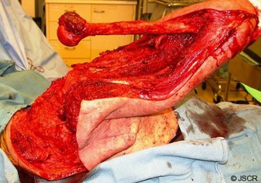 Harvest and “de-boning” of flap from patient's right upper arm.