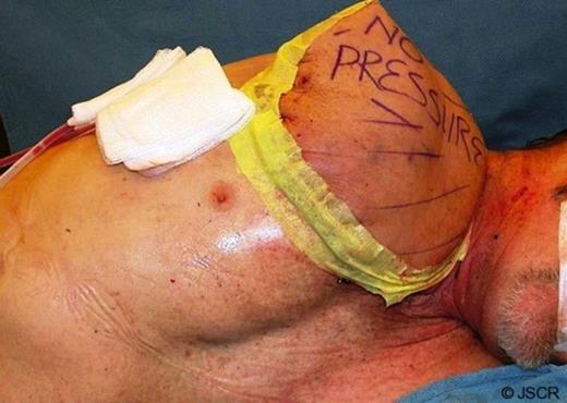 Flap closure post-op