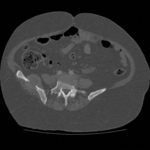Axial CT image of abdomen demonstrating the mass noted in the right iliac bone of the pelvis measuring 4.5cm transversely.