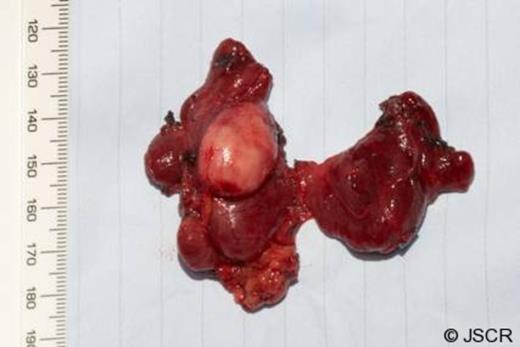 Total thyroid specimen with a 2.5cm nodule evident within the right thyroid lobule.