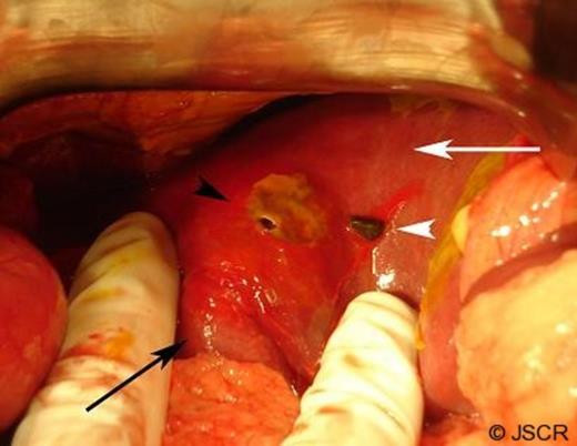 Laparotomy showing the inflamed gallbladder (black arrow), the liver (white arrow), perforation in the liver (black arrowhead), and a gallstone lying adjacent to the perforation (white arrowhead).