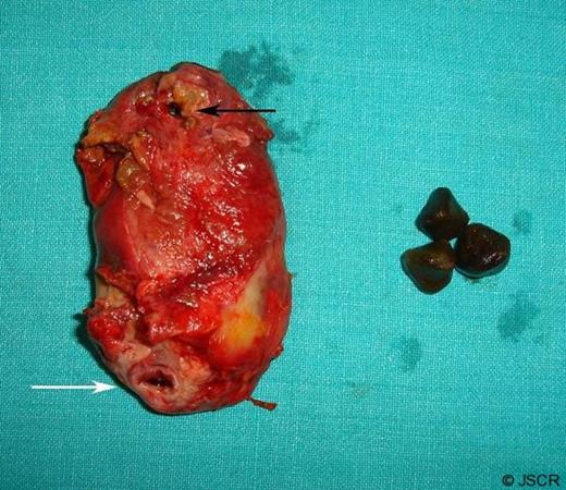 The excised gallbladder specimen showing the perforation (black arrow) and the cystic duct opening (white arrow).