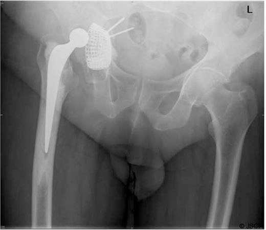A pelvic radiograph showing migration of the acetabular construct