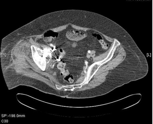 A CT Scan of the pelvis showing compression of external iliac vein by acetabular screw