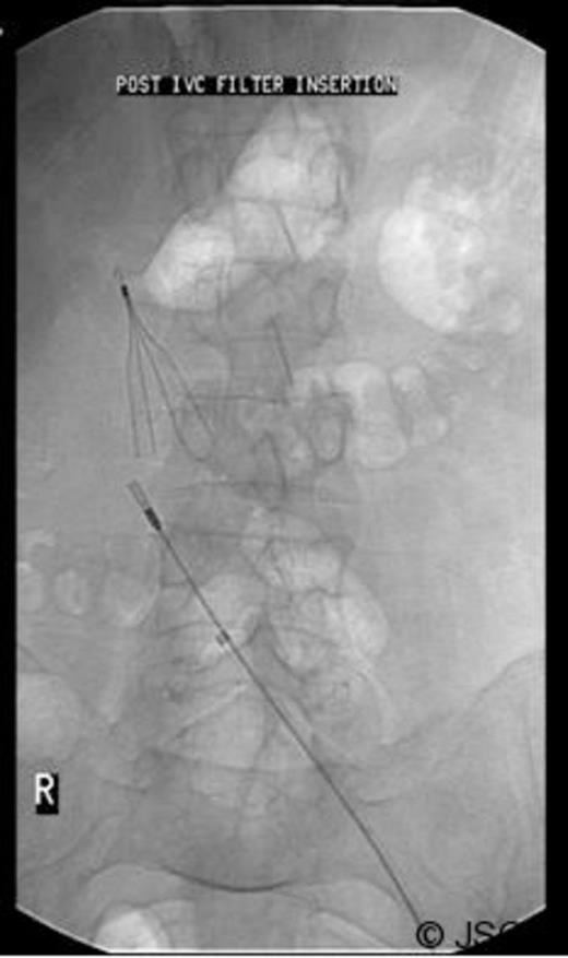 Inferior vena cava (IVC) filter inserted prior to revision surgery