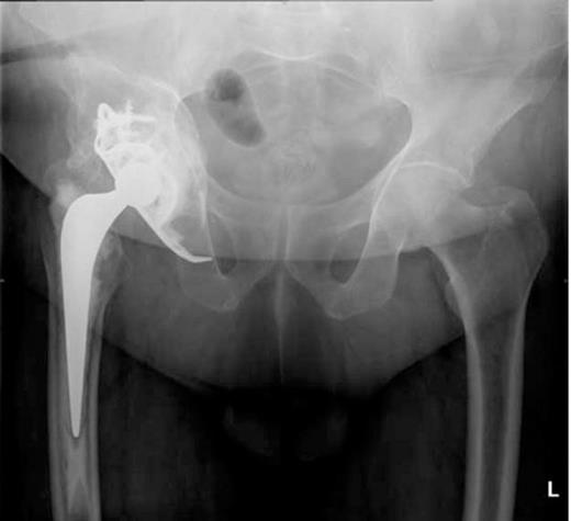 Pelvic radiograph following revision hip arthroplasty