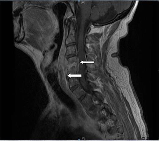 Sagittal T1 image. There is an extensive retro-pharyngeal enhancing collection. In addition there is an epidural collection extending from C2 to C5/6.
